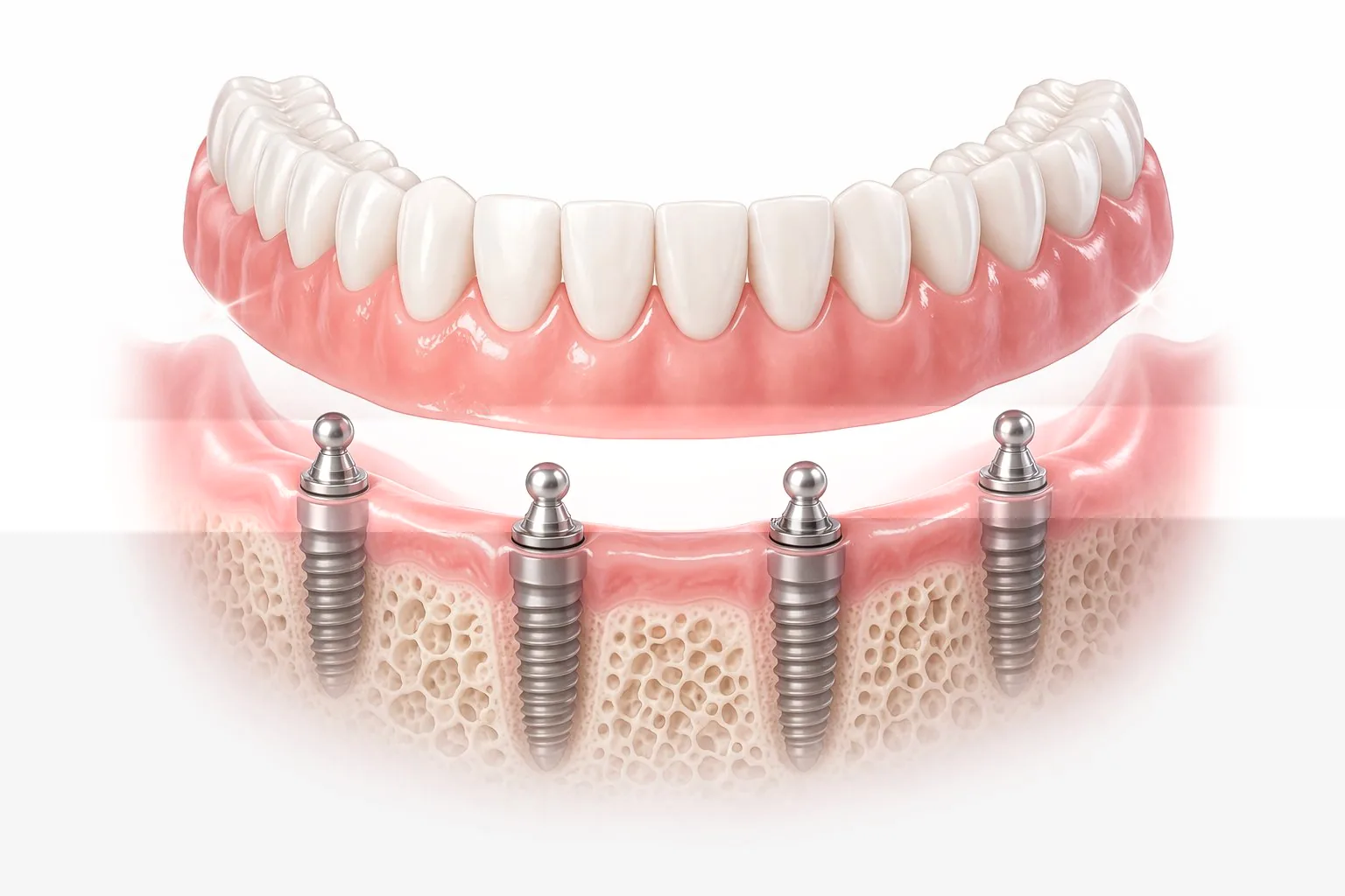 Implant-supported dentures in Wilmington, DE